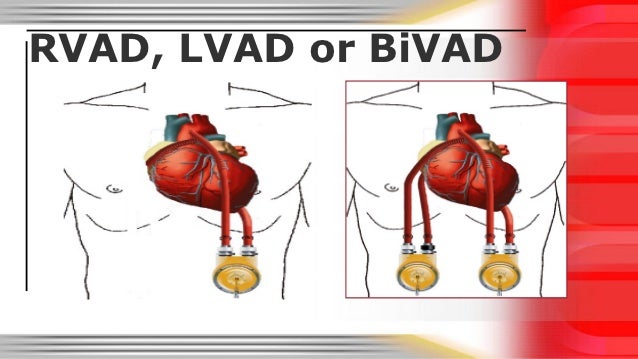 VAD Ventricular Assist Device