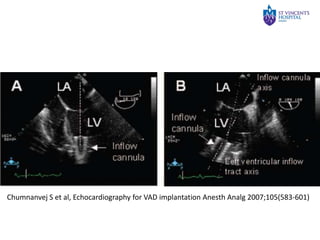 Ventricular Assist Devices | PPTX