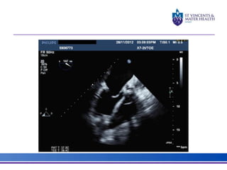 Ventricular Assist Devices | PPTX