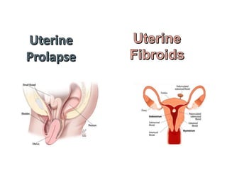 Uterine Fibroids
 