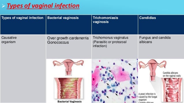 bacterial-vaginosis-oral-sex-pussy-fuck-sexy