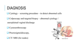 DIAGNOSIS
 Cytology – screening procedure – to detect abnormal cells
 Colposcopy and targeted biopsy – abnormal cytology /
unexplained vaginal discharge
 Cystourethroscopy
 Proctosigmoidoscopy,
 CT/ MRI (for nodes)
 