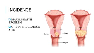 INCIDENCE
 MAJOR HEALTH
PROBLEM
 ONE OF THE LEADING
SITE
 