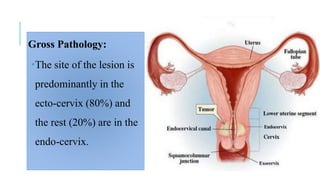 Gross Pathology:
The site of the lesion is
predominantly in the
ecto-cervix (80%) and
the rest (20%) are in the
endo-cervix.
 