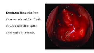 Exophytic: These arise from
the ecto-cervix and form friable
masses almost filling up the
upper vagina in late cases.
 