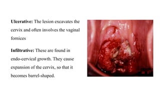 Ulcerative: The lesion excavates the
cervix and often involves the vaginal
fornices
Infiltrative: These are found in
endo-cervical growth. They cause
expansion of the cervix, so that it
becomes barrel-shaped.
 