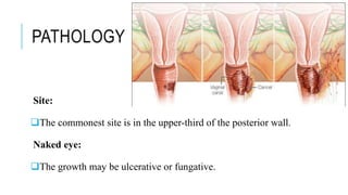 PATHOLOGY
Site:
The commonest site is in the upper-third of the posterior wall.
Naked eye:
The growth may be ulcerative or fungative.
 