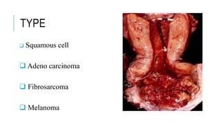 TYPE
 Squamous cell
 Adeno carcinoma
 Fibrosarcoma
 Melanoma
 