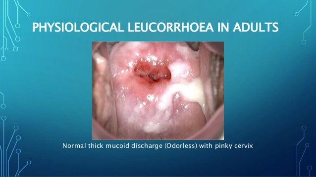 pics Pinkish Grey Discharge vaginal discharge