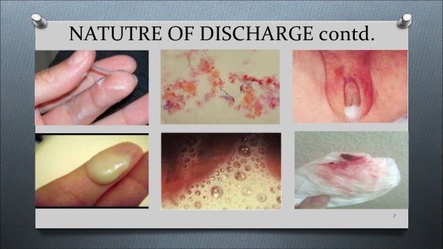 vaginal discharge 1