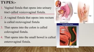 TYPES:-
1. Vaginal fistula that opens into urinary
tract called vesicovaginal fistula.
2. A vaginal fistula that opens into rectum
is called rectovaginal fistula
3. That opens into the colon is called
colovaginal fistula.
4. That opens into the small bowel is called
enterovaginal fistula.
 