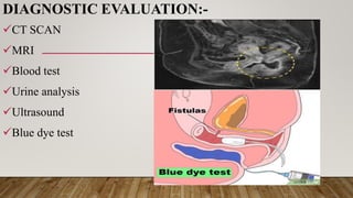 DIAGNOSTIC EVALUATION:-
CT SCAN
MRI
Blood test
Urine analysis
Ultrasound
Blue dye test
 