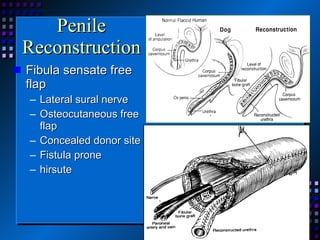 Penile Reconstruction Fibula sensate free flap Lateral sural nerve Osteocutaneous free flap Concealed donor site Fistula prone hirsute 