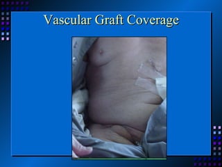 Vascular Graft Coverage 
