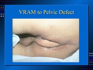VRAM to Pelvic Defect 