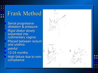 Frank Method Serial progressive dilatation & pressure Rigid dilator slowly expanded into rudimentary vagina Placed between rectum and urethra painful 12-24 months High failure due to non-compliance 