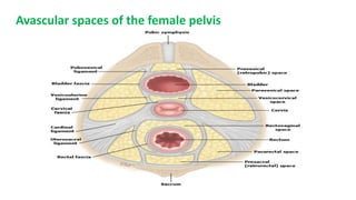 Avascular spaces of the female pelvis
 