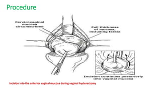Procedure
Incision into the anterior vaginal mucosa during vaginal hysterectomy
 