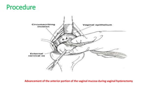 Advancement of the anterior portion of the vaginal mucosa during vaginal hysterectomy
Procedure
 