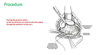 Procedure
Incising the posterior pelvic
cul-de-sac (Scissors are used to enter the vagina
through the posterior cul-de-sac.)
 