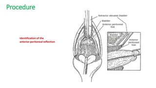 Procedure
Identification of the
anterior peritoneal reflection
 