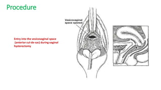 Procedure
Entry into the vesicovaginal space
(anterior cul-de-sac) during vaginal
hysterectomy
 