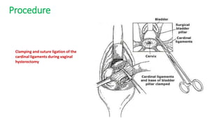 Procedure
Clamping and suture ligation of the
cardinal ligaments during vaginal
hysterectomy
 
