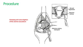 Procedure
Clamping and suture ligation
of the uterine vasculature
 