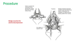Procedure
Wedge resection for
uterine decompression
 