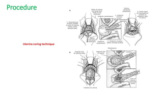 Procedure
Uterine coring technique
 
