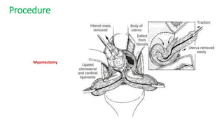 Procedure
Myomectomy
 