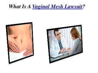 What Is A Vaginal Mesh Lawsuit?
 