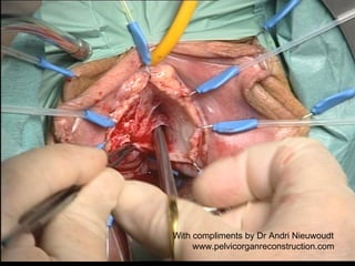 With compliments by Dr Andri Nieuwoudt www.pelvicorganreconstruction.com 