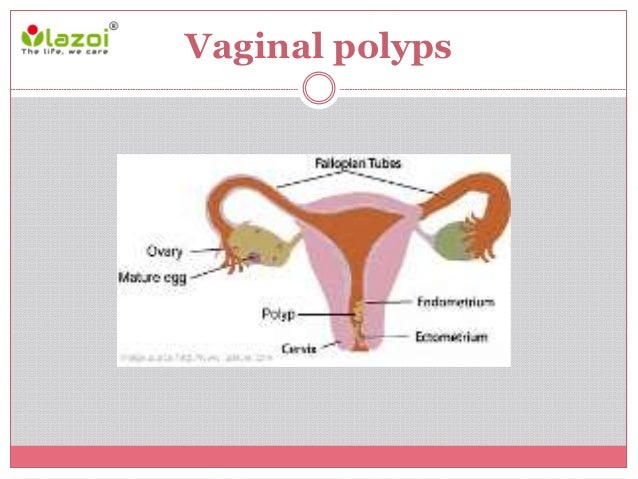 Vaginal Polyps vaginal-polyps