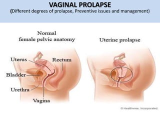 VAGINAL PROLAPSE
(Different degrees of prolapse, Preventive issues and management)
 