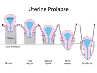 Uterine Prolapse
 