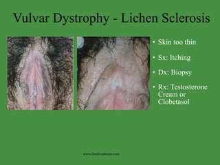 Vaginal prurities