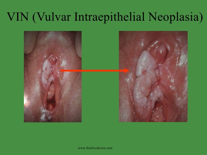 Lichen sclerosus (patientenfolder) - huidziekten.nl