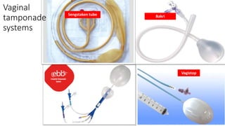 Vagistop
Bakri
Sengstaken tube
Vaginal
tamponade
systems
 