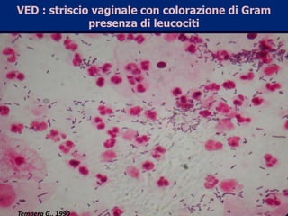 VED : striscio vaginale con colorazione di Grampresenza di leucocitiTempera G., 1990
