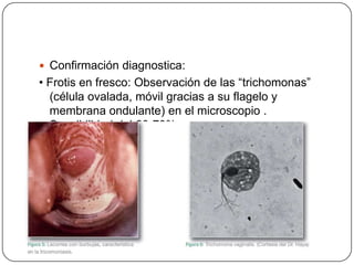  Confirmación diagnostica:
• Frotis en fresco: Observación de las “trichomonas”
  (célula ovalada, móvil gracias a su flagelo y
  membrana ondulante) en el microscopio .
  Sensibilidad del 60-70%.
 