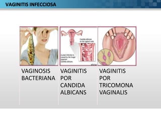 VAGINITIS INFECCIOSA
VAGINOSIS
BACTERIANA
VAGINITIS
POR
CANDIDA
ALBICANS
VAGINITIS
POR
TRICOMONA
VAGINALIS
 