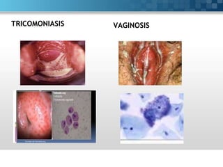 Vaginosis bacteriana | PPT