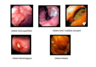 Ulcère rond superficiel   Ulcère rond / ovalaire creusant




 Ulcère hémorragique        Ulcère linéaire
 