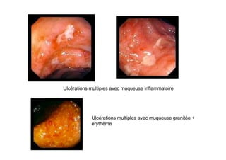 Ulcérations multiples avec muqueuse inflammatoire




            Ulcérations multiples avec muqueuse granitée +
            erythème
 