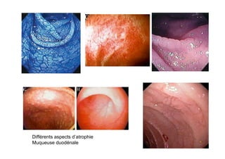Différents aspects d’atrophie
Muqueuse duodénale
 