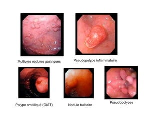 Multiples nodules gastriques      Pseudopolype inflammatoire




                                                        Pseudopolypes
Polype ombiliqué (GIST)         Nodule bulbaire
 