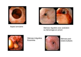 Aspect annulaire
                                         Sténose régulière avec ulcération
                                         ou hémorragie en amont



                   Sténose irrégulière                        Sténose post-
                   Excentrée                                  Ulcére bulbaire
 