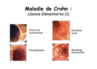 Maladie de Crohn :
 Lésions élémentaires (1)



 Cicatrices                 Erythème
 d’ulcérations              franc




 Pseudopolypes              Muqueuse
                            boursouflée
 