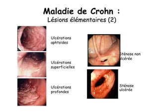 Maladie de Crohn :
 Lésions élémentaires (2)

  Ulcérations
  aphtoïdes


                            Sténose non
                            ulcérée
  Ulcérations
  superficielles




  Ulcérations               Sténose
                            ulcérée
  profondes
 